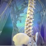 what are the symptoms of a failed lumbar fusion